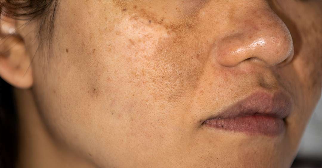 Ultimate Hyperpigmentation Treatment in Islamabad